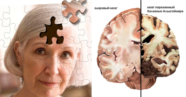 Ученые нашли возможность разработки системы ранней диагностики болезни Альцгеймера.